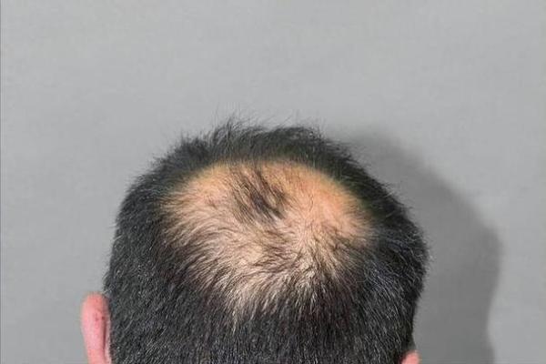 中年秃头的命格与人生哲学探讨:智慧与魅力的别样体现 中年秃头的命格与人生哲学探讨:智慧与魅力的别样体现