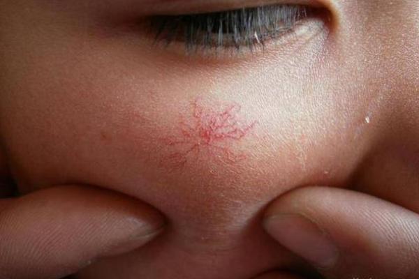 探秘后背长红痣的命运象征与意义 探秘后背长红痣的命运象征与意义