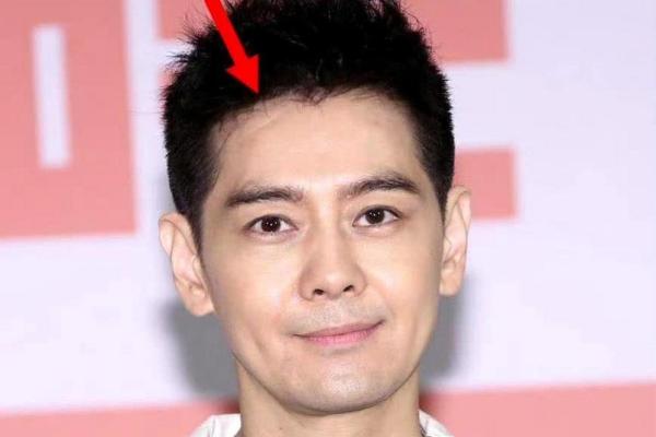 额头凹陷疤痕暗示的命运:了解它的深层含义与影响 额头凹陷疤痕暗示的命运:了解它的深层含义与影响