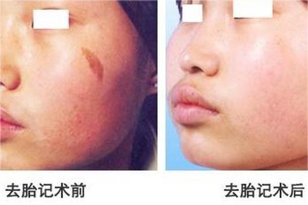 头顶长胎记的人，命运何其不同？探秘胎记的奥秘与缘分