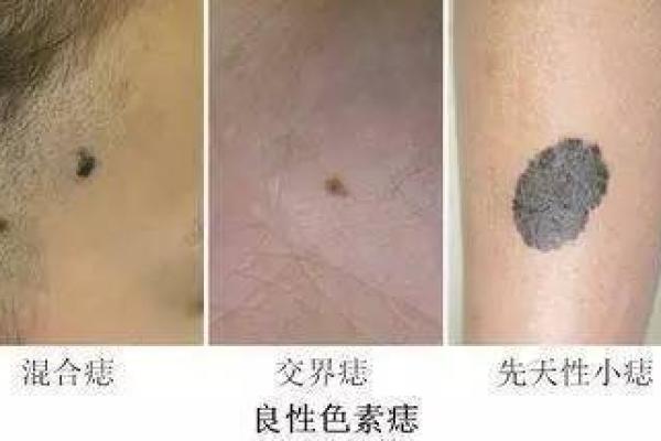 腋下胎记的神秘寓意：揭示潜藏在你命运中的秘密