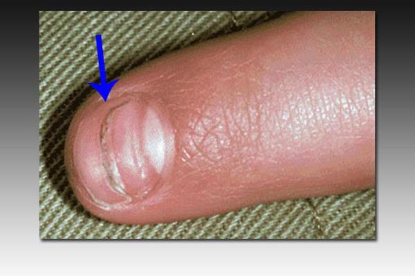 男生指甲薄的秘密：揭示命运与性格的微妙联系