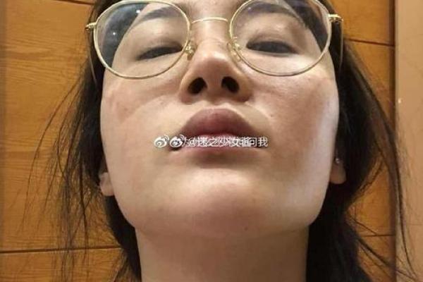 探秘下颌角肥大的背后：美丽与健康的双重挑战
