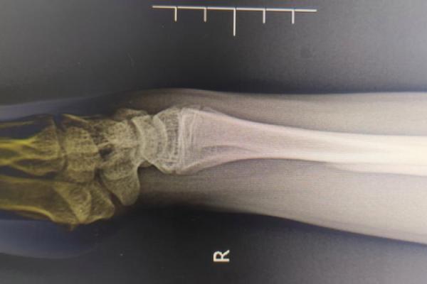 男人右手小指弯曲暗示的命运解析：揭示你特别的生命密码