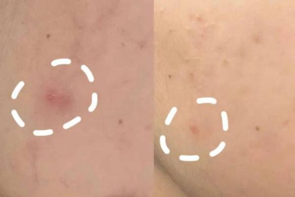 长痘痘的人是什么命？探讨面部痘痘与命运的奥妙！