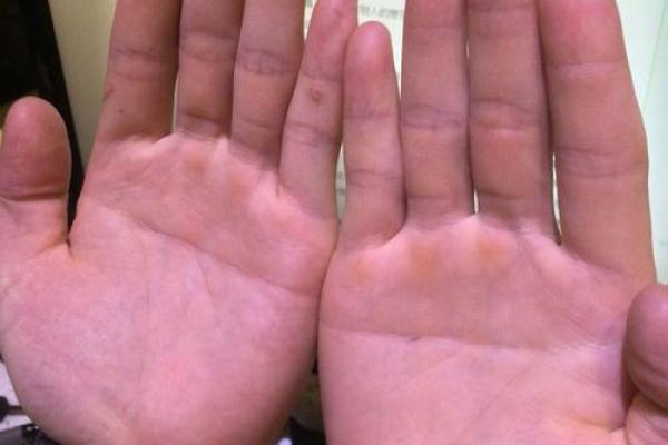 探索命理学之谜：双手断掌的深意与象征