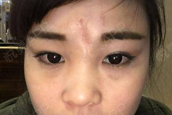 女生印堂凹陷解析：命运与性格的微妙关联