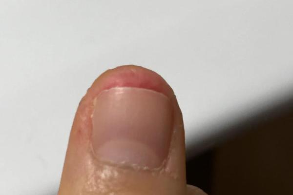 手指大拇指疼痛的原因及应对方法，助你恢复健康生活！