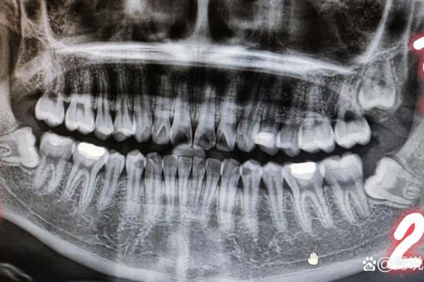 拔牙在命理学中的深层含义与启示