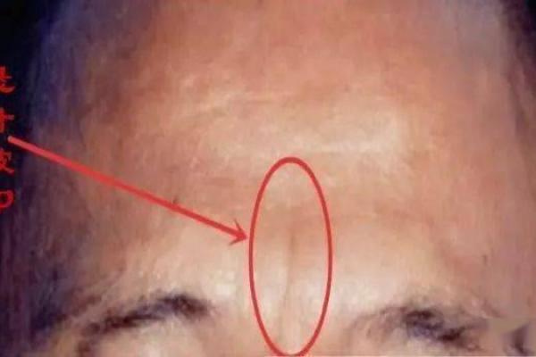 孩子的鼻梁塌陷,是命运的印记还是成长的选择? 孩子的鼻梁塌陷,是命运的印记还是成长的选择?