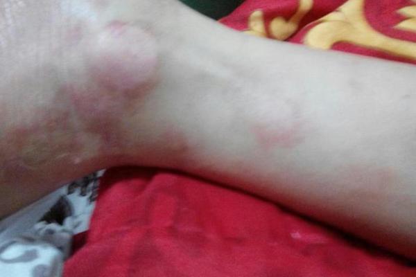 小腿红色胎记的奥秘：命运与美丽的交织