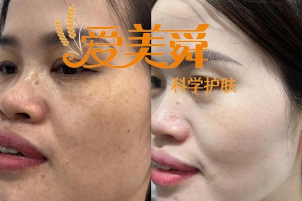 雀斑女孩的命运:从外貌到内心的转变与成长 雀斑女孩的命运:从外貌到内心的转变与成长