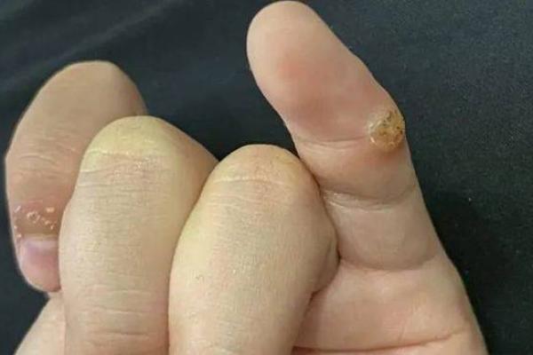 手上有瘊子的人，命运的秘密与生活的智慧