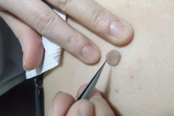 脑后长瘊子，象征着什么命运？解密背后的未知秘密！