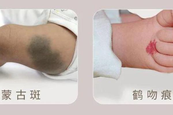 褐色胎记的命格解析：揭示生命中的吉凶秘密