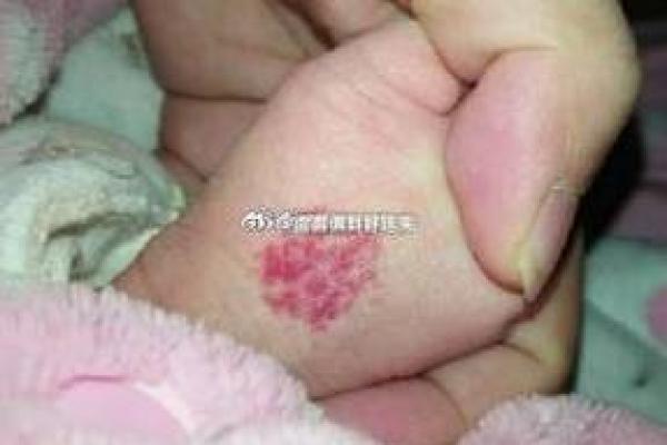 带胎记的人命运如何？探索胎记与个性命运的神秘关系
