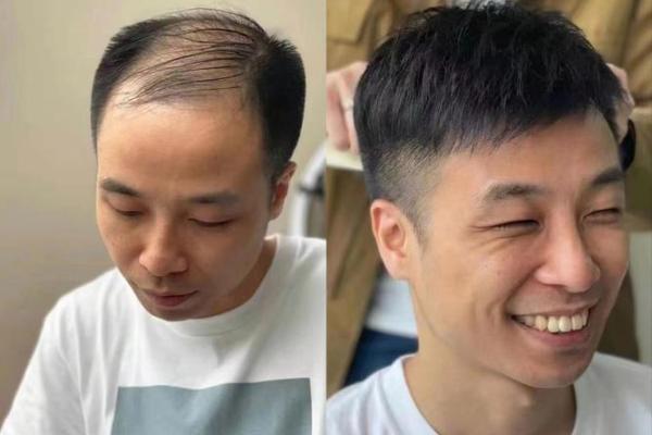 20岁就秃头？年轻人背负的压力与自信危机