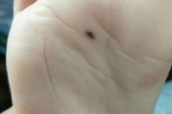 脚底有痣：揭示你命运的神秘符号