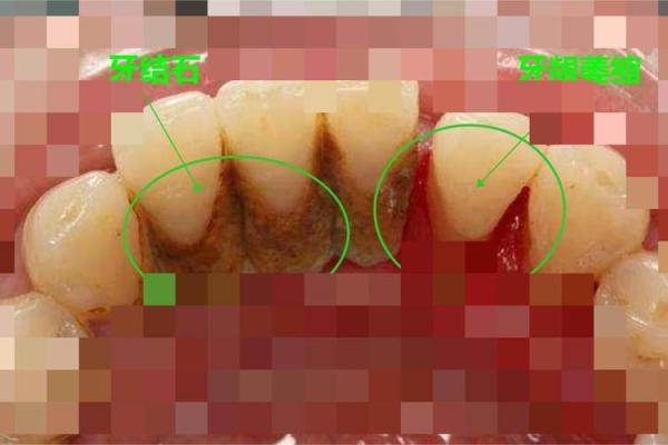 20颗牙齿的命运：从口腔健康看人生哲学