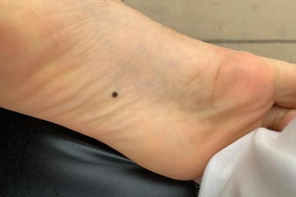 脚心有痣，脚印人生：解析脚心痣的命理意义与吉凶