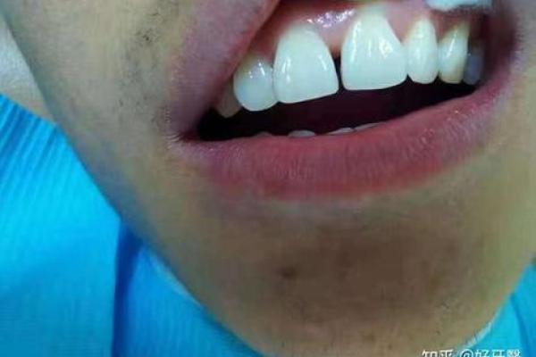面相解密：牙缝大小对命运的潜在影响