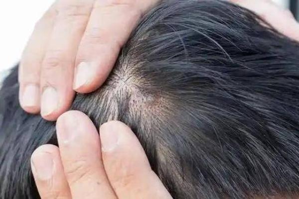 头上长脓包的原因及其隐藏的健康信号