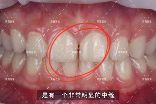 面相学揭秘：牙缝大小影响命运的深层次解析