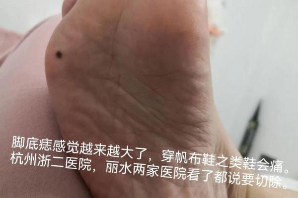 脚下的痣：解密命运的秘密符号