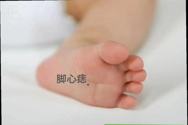脚下的痣：解密命运的秘密符号