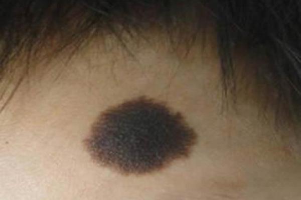 了解右胳膊胎记的命运寓意，解读人生秘密与命理之道
