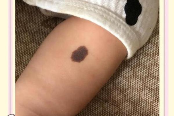 没有胎记的人命运如何？揭开命理的神秘面纱！