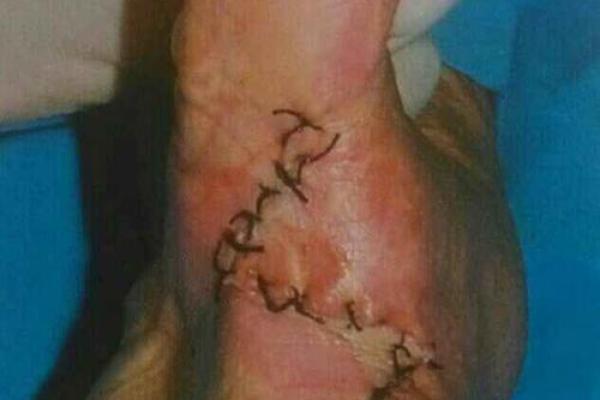 虎口有疤痕，命运与人生的深刻启示