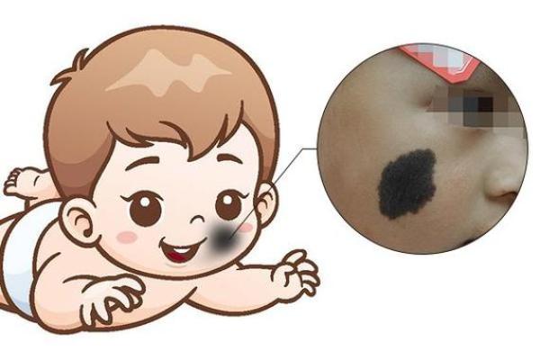 臀部胎记的命运解析:它们隐含的秘密与未来的指引 臀部胎记的命运解析:它们隐含的秘密与未来的指引